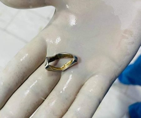 فريق طبي عراقي ينقذ حياة طفل ابتلع حلقة معدنية