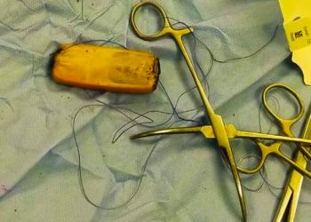 أطباء يستخرجون (هاتفاً محمولاً) من معـــدة مريض ابتلعه قبل 6 أشهر