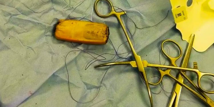 أطباء يستخرجون (هاتفاً محمولاً) من معـــدة مريض ابتلعه قبل 6 أشهر
