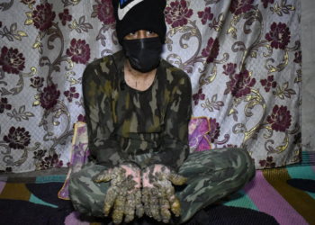 أندر حالة مرضية في العراق ,,( الرجل الشجرة )