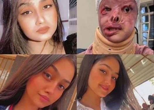 مأساة تهز العراق ,, شاب يشوه جسد فتاة بـ”التيزاب” لرفضها الزواج منه ‎#انقذوا_الاميرة_مريم