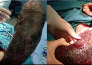 اكتشاف شيء “مرعب” داخل معدة مريضة بسبب مرض سلوكي نادر