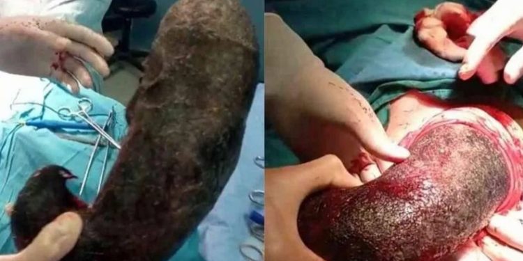 اكتشاف شيء “مرعب” داخل معدة مريضة بسبب مرض سلوكي نادر