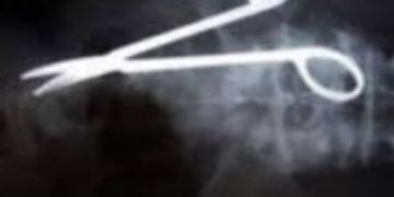 استخراج مقص من بطن سيدة في بنجلادش بعد 20 عاما