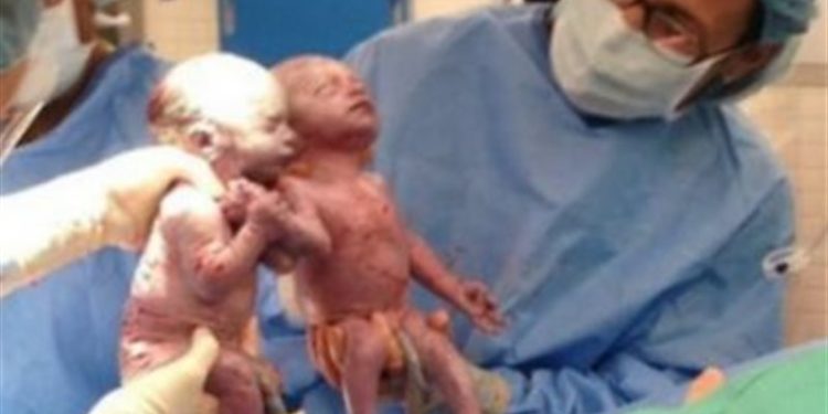 ولادة نادرة لتوأم في إسبانيا ,,, تحدث كل 85 ألف حالة