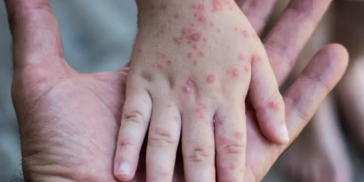  أبرز أعراض مرض “جدري القردة” بعد انتشاره الواسع