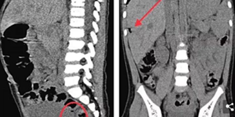 إصابة طفلة بثقب في الأمعاء وصديد في الكبد .. بسبب لعبة
