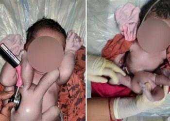بالصور ولادة طفلة بــ(أربع أذرع وأربع أرجل) تثيــر ضجة واسعة
