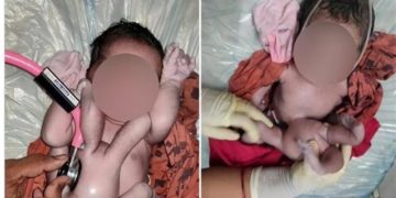 بالصور ولادة طفلة بــ(أربع أذرع وأربع أرجل) تثيــر ضجة واسعة