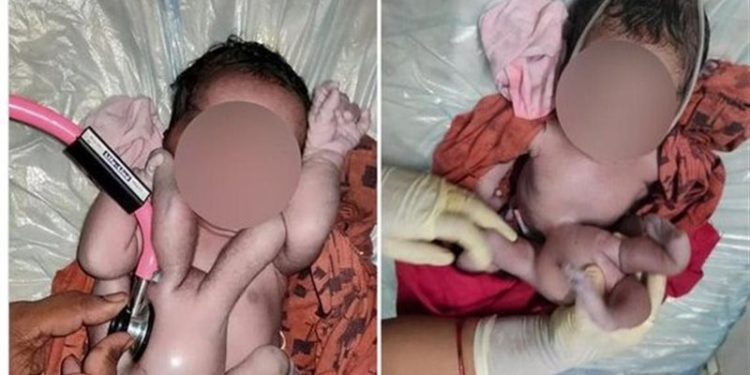 بالصور ولادة طفلة بــ(أربع أذرع وأربع أرجل) تثيــر ضجة واسعة