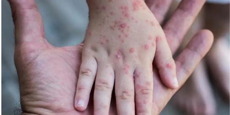 دولة أوربية تسجل أكثر من 400 حالة إصابة بمرض جدري القردة