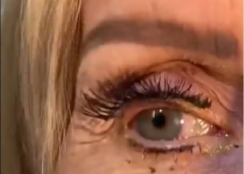 امرأة تنسى 23 عدسة لاصقة في إحدى عينيها