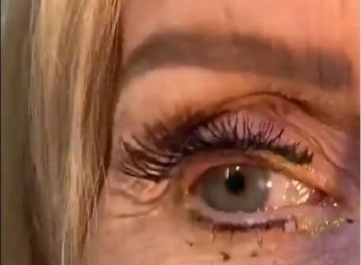 امرأة تنسى 23 عدسة لاصقة في إحدى عينيها