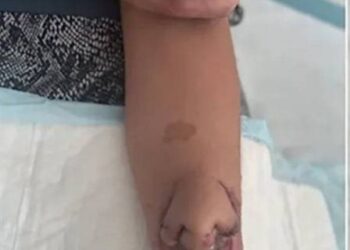 بعد نموه على ذراعها ,, أول عملية زراعة أنف على وجه إمرأة فرنسية