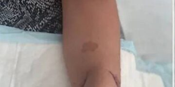 بعد نموه على ذراعها ,, أول عملية زراعة أنف على وجه إمرأة فرنسية