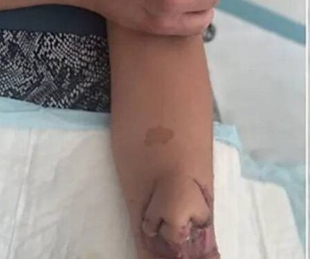 بعد نموه على ذراعها ,, أول عملية زراعة أنف على وجه إمرأة فرنسية