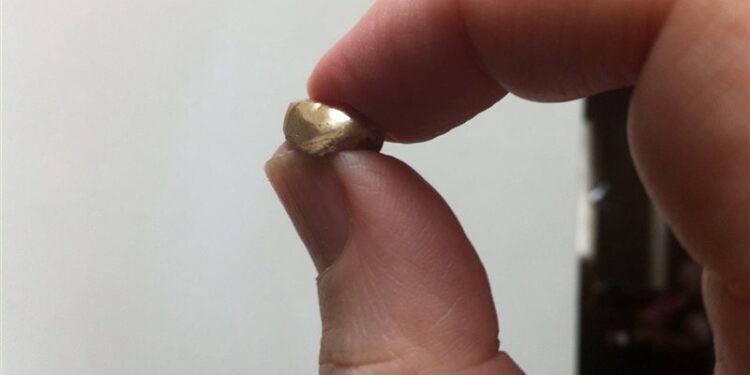 ممرض يسرق ضرسا ذهبيا من فم ميت