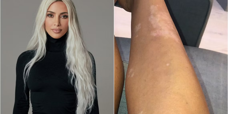 مرض أصاب عددًا من المشاهير بينهم كيم كارداشيان