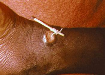 داء التنين ,, أول مرض في العالم يتم القضاء عليه دون لقاح أو علاج