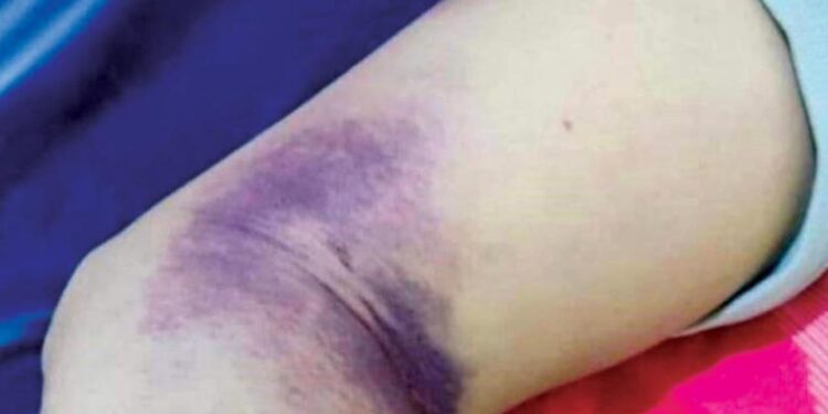 إصابة رجل بالحمى النزفية في ذي قار