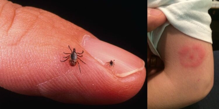 اليابان .. اعلان أول وفاة بـ(فيروس أوز) جراء عضة قراد