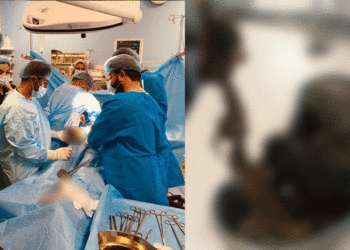 السليمانية .. إخراج كمية كبيرة من الشعر من داخل معدة مريض “حالة نادرة “
