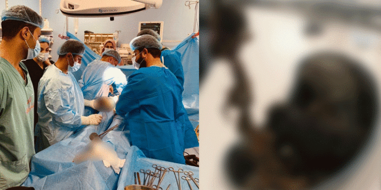 السليمانية .. إخراج كمية كبيرة من الشعر من داخل معدة مريض “حالة نادرة “