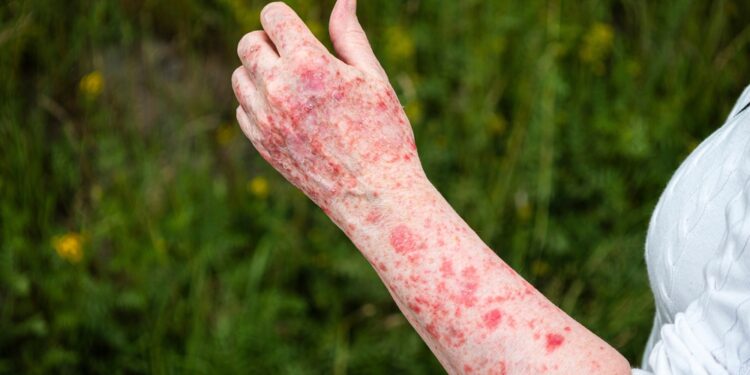 “التسمم الشمسي” مرض ينتشر خلال فصل الصيف