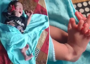 الهند .. ولادة رضيعة بــ 26 إصبعًا