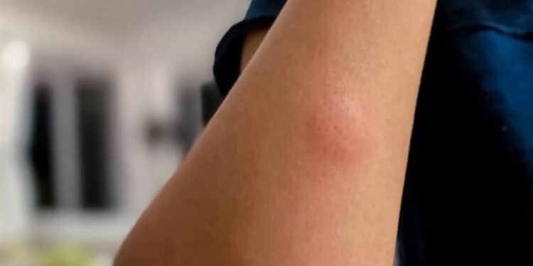 فيروس “غرب النيل” يهـــاجم سكان كاليفورنيا