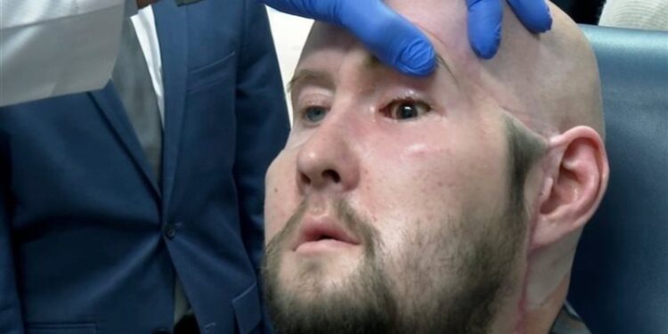 نجاح عملية زرع عين كاملة ,,, لأول مرة في العالم