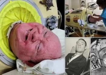 وفاة رجل الرئة الحديدية بعد 70 عاما من المعاناة