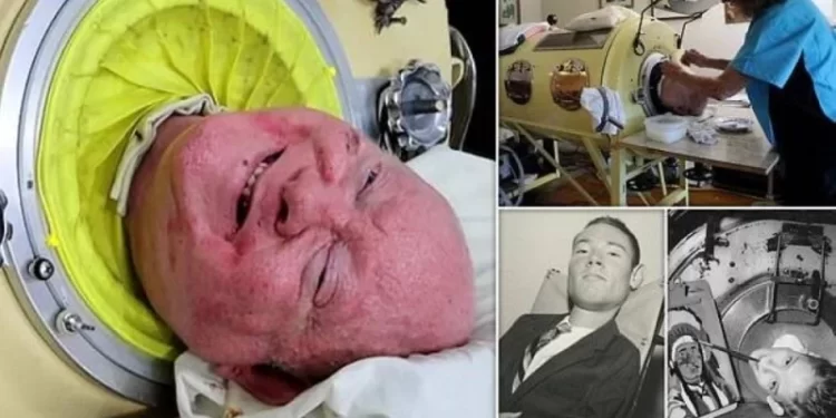 وفاة رجل الرئة الحديدية بعد 70 عاما من المعاناة