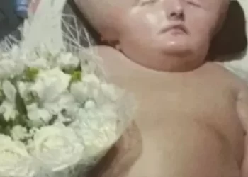 البرازيل .. حالة نادرة لطفلة رأسها لا يتوقف عن النمو