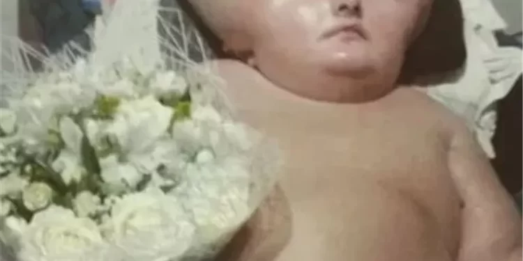 البرازيل .. حالة نادرة لطفلة رأسها لا يتوقف عن النمو