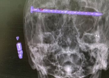 إخراج مسمــار طوله 15 سم من رأس رجل في الأورال الروسية