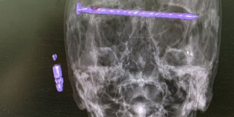 إخراج مسمــار طوله 15 سم من رأس رجل في الأورال الروسية