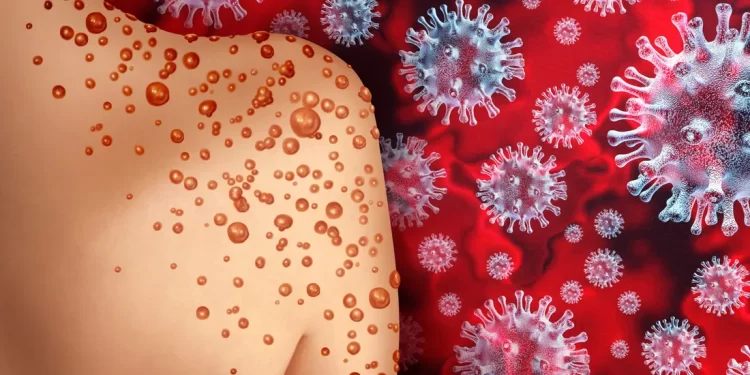 الصحة العالمية تعلن جدري القرود حالة طوارئ صحية