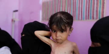 الأمم المتحدة.. سوء التغذية يتفاقم في مناطق سيطرة الحكومة اليمنية