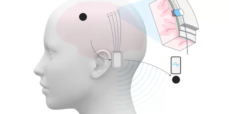 ماسك يعلن نجاح زرع شريحة دماغية لشخص ثالث