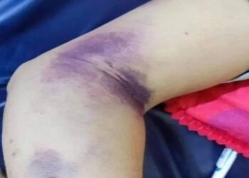 البصرة.. يســـجل 7 حالات إصابة بالحمى النزفية