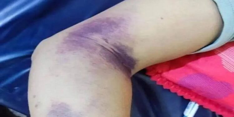 البصرة.. يســـجل 7 حالات إصابة بالحمى النزفية