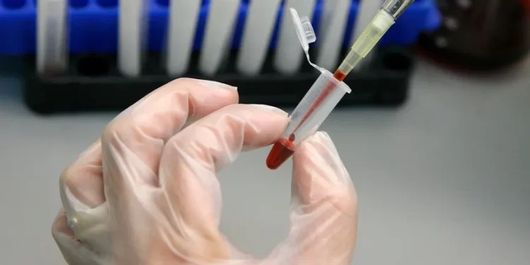 تركيبة دوائية جديدة ربما تنجـــح في عـــــلاج “اللوكيميا الحادة”