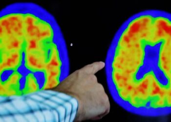 الفارق بين الخرف والنسيان الطبيعي