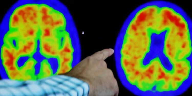 الفارق بين الخرف والنسيان الطبيعي